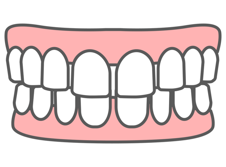 空隙歯列（くうげきしれつ）