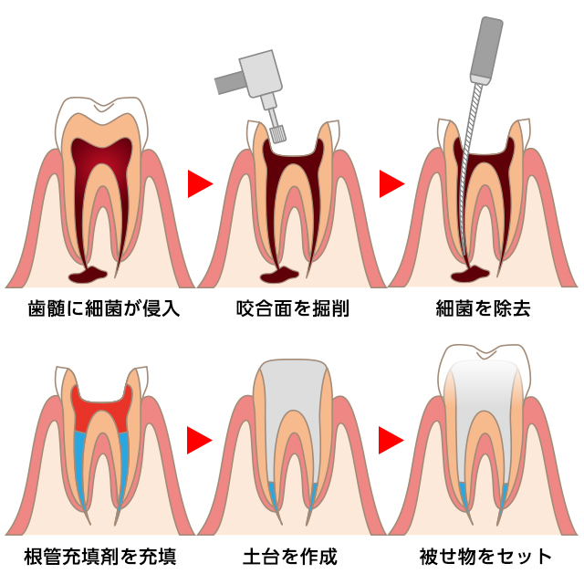 できるだけ歯を残す・抜かない治療