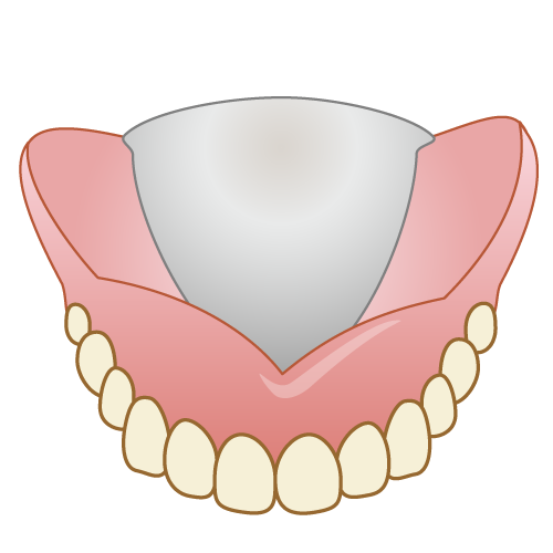 金属床義歯