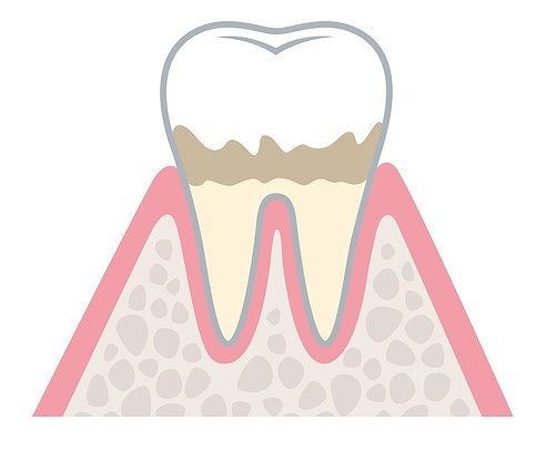 歯周病の進行段階