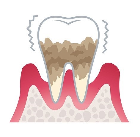 重度歯周炎