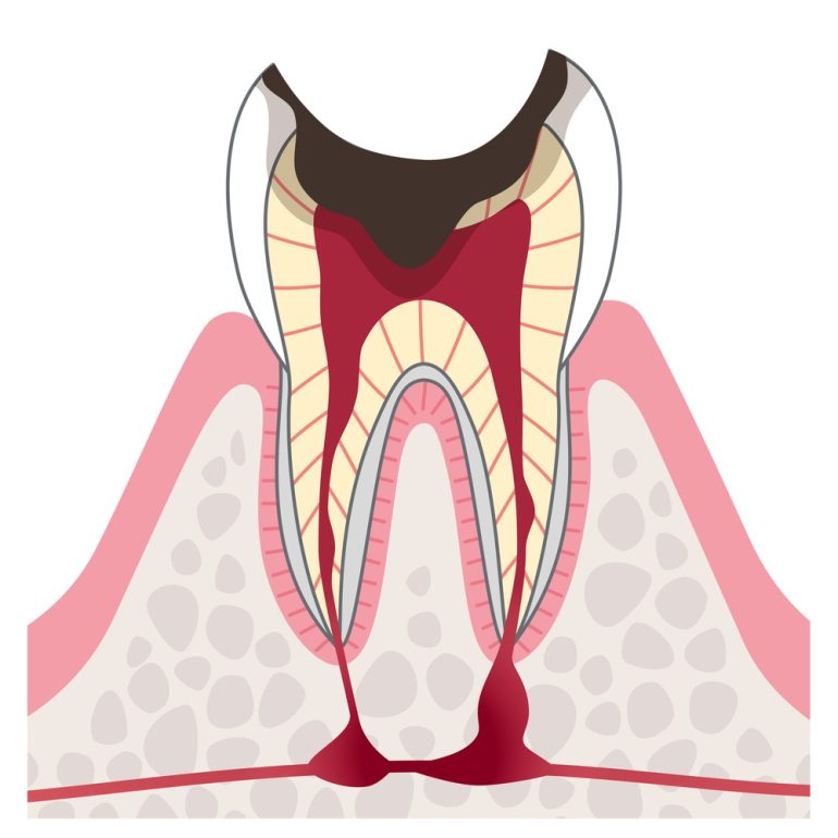 C4:歯根にまで達した虫歯