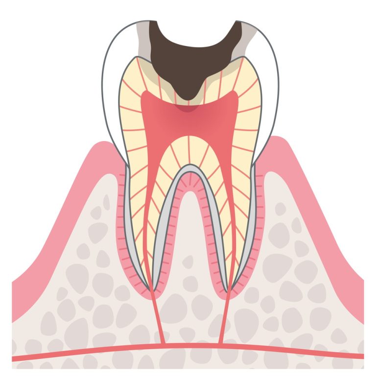 C3:歯の神経に達した虫歯