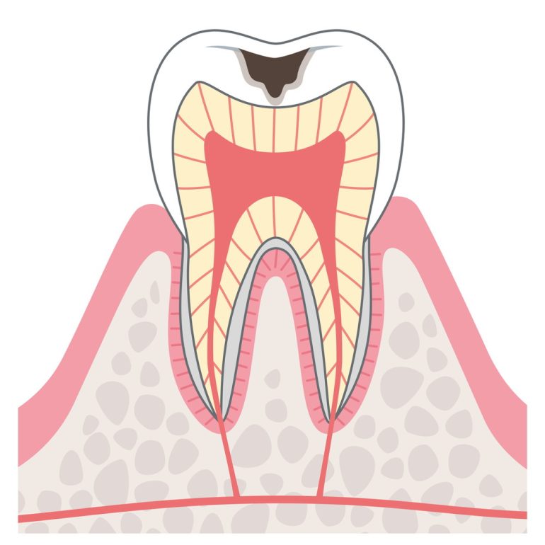 C2:象牙質の虫歯
