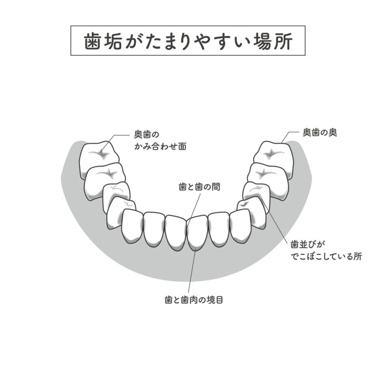 「染め出し」でむし歯になりやすい箇所を確認しましょう！