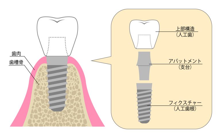 人工歯の装着